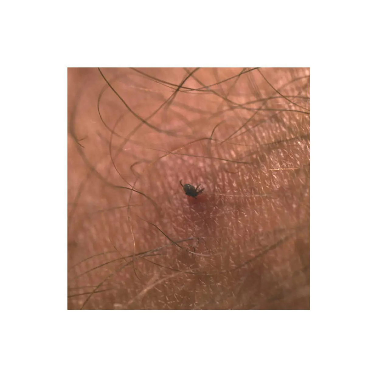 Tick Remover Tool